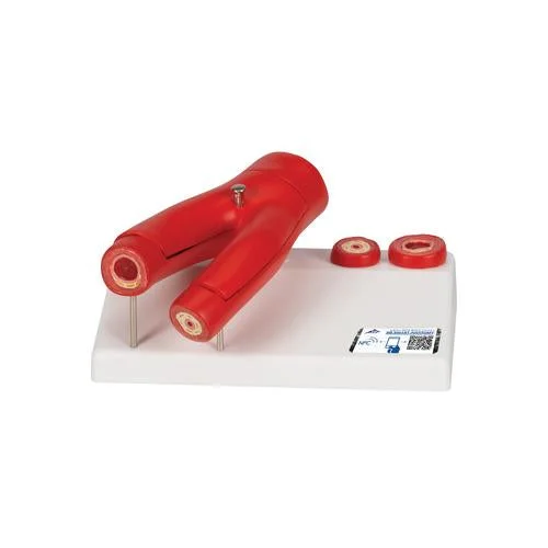 Arteriosclerosis Model, with Cross Section of Artery, 2 part – 3B Smart Anatomy – 1000278