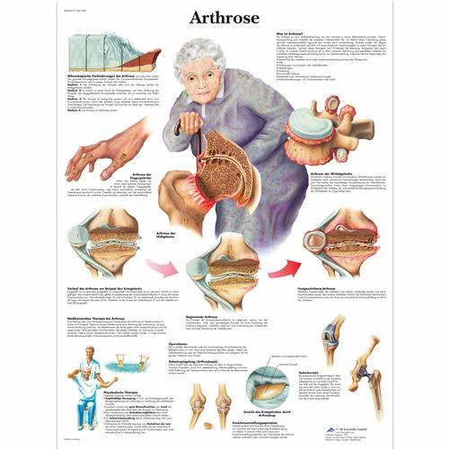 Arthrose – 4006571
