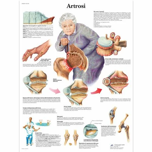 Artrosi – 4006899