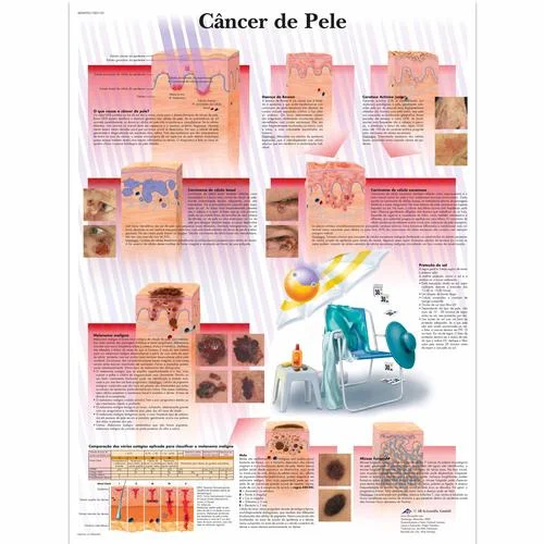 Câncer de Pele – 4006993
