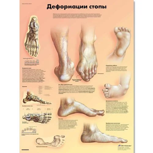 Deformities of the Feet Chart – 1002234